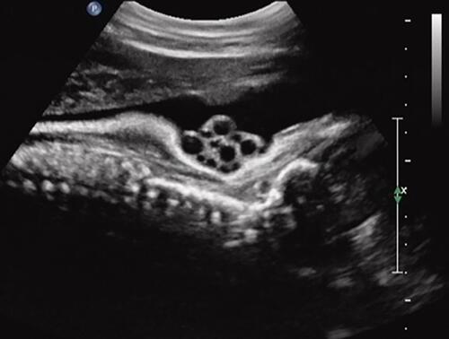 Figure 2 Sagittal imaging of the fetal neck. Fetal cranium is to the right of the image. Real-time sonography depicting a quadruple nuchal cord. Note the prominent “divot sign” representing marked subcutaneous indentation of the fetal skin overlying the posterior aspect of the fetal neck, exerted by pressure of the four loops of nuchal cord upon the fetal neck. Also note that each of the larger umbilical veins is accompanied by two (smaller caliber) umbilical arteries, respectively.