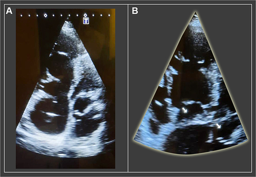 Figure 1 (A) Outpouching of mitral valve that is expanding during systole and collapsing during diastole. (B) Bilateral aneurysm of the mitral and tricuspid valve.