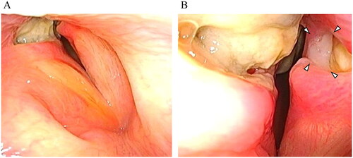 Figure 1. Endoscopic imaging findings at the initial visit. (A) The bilateral vocal cords have oedema and redness, and necrotic tissue with an ulcer is on the surface of the bilateral posterior glottic region. (B) A portion of the left arytenoid cartilage is exposed (surrounded by arrowheads).