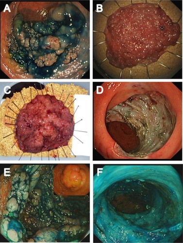 Figure 3 Examples of appropriate selection of resection technique.