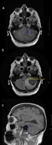 Figure 1. MRI brain showing left cerebellar lesion with significant amount of surrounding vasogenic edema, ipsilateral transtentorial herniation, and obliteration of the fourth ventricle.