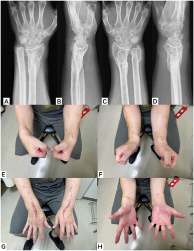 Figure 5. Plain x-ray, appearance, and range of motion of both wrists 1 year postoperatively. (A,B) Plain x-ray of the left wrist; (C,D) plain x-ray of the right wrist; (E) active palmar flexion; (F) active dorsiflexion; (G) forearm pronation; (H) forearm supination.