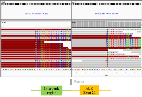 Figure 3 Sequencing reads of IGR and ALK were visualized by the Integrative Genomics Viewer (IGV). The schematic below shows the IGR (upstream YPEL5-) ALK fusion.