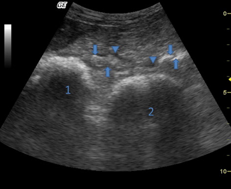 Figure 5. Ultrasonogram showing echogenic fibrin deposits on reticulum and craniodorsal blind sac of rumen in the sheep viewed from the left ventral thorax. (1) Reticulum, (2) craniodorsal blind sac of rumen, arrows: echogenic fibrin deposits, arrowheads: anechogenic fluids pockets.