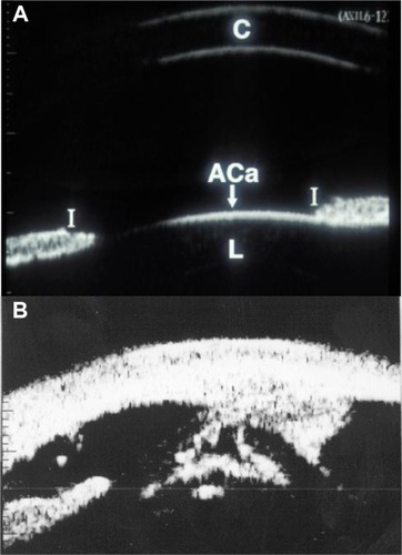 Figure 1 Ultrasound biomicroscopy images.