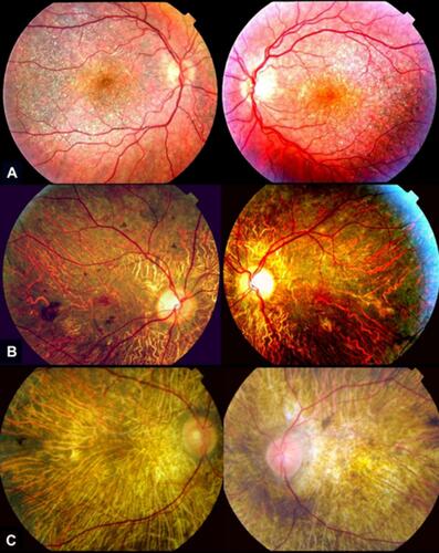 Figure 2 Color retinography of the fundus of both eyes of different patients showing different degrees of evolution of BCD disease, according to Yuzawa classification. (A) Numerous glistening crystalline dots and minimal chorioretinal damage restricted to the posterior pole of the retina, corresponding with stage 1 of Yuzawa. (B) Epithelial confluent atrophy of the posterior pole and few crystalline deposits, corresponding with stage 2 of Yuzawa. (C) Advanced choroidal sclerosis with marked chorioretinal atrophy and absence of deposits, corresponding with stage 2 of Yuzawa. Misdiagnosing with severe forms of choroideremia or retinitis pigmentosa is possible.
