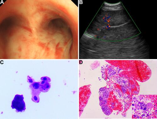 Figure 3 The image of fiber bronchoscopy, endobronchial ultrasonography (EBUS), and pathology. (A) Fibronchofibroscope examination reveals a focal mucosal thickening of the right tracheal wall. (B) EBUS shows right pulmonary neoplasm. (C) The bronchoalveolar lavage fluid is composed of inflammatory cells with few heteromorphic cells. (D) The pathologic evaluation suggests hepatoid adenocarcinoma of the lung.