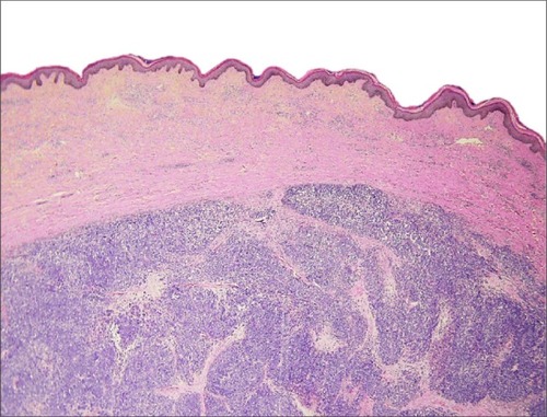 Figure 1 Hematoxylin and eosin slide 2×10, Merkel cell carcinoma.