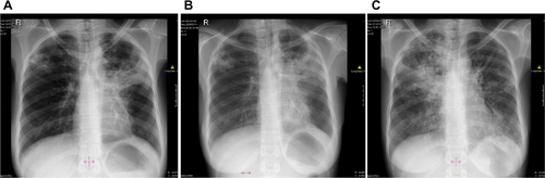Figure S3 Chest X-rays of Patient 3 depicting (A) cavities and infiltrates in both lungs; (B) cavities and infiltrates on the right lung and fibrosis in the left lung; and (C) cavities, infiltrates, and patchy consolidation in the right lung and consolidation in mid and lower zones of the left lung.