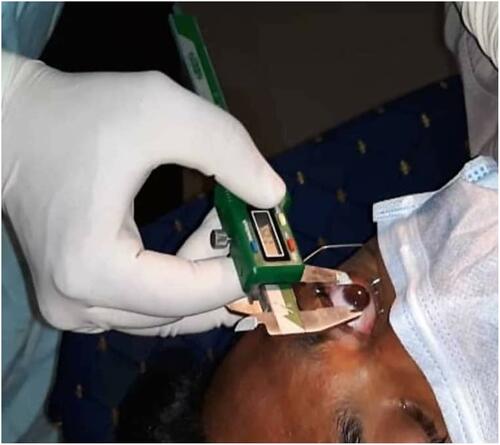 Figure 2 Demonstrating Digital callipers to measure white to white diameter of cornea.