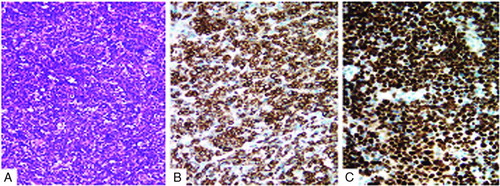 FIGURE 2  Histology and immunohistochemistry. (A) Tumor tissue showed “starry-sky” appearance with medium-sized lymphocytes. Hematoxylin and eosin (HE) stain, original magnification × 200. (B) Positive CD79a on the membrane of the tumor cell (magnification × 400). (C) More than 95% of cells expressed Ki-67 (magnification × 400).