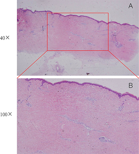 Figure 4 Hematoxylin-eosin (HE) staining of the pathology slide showing the dermis is generally normal, with coarse reddish staining of the deep dermal collagen proliferation, upward displacement of the small sweat glands and visible extrusion, and infiltration of lymphocytes, histiocytes, and a small number of plasma cells seen around the blood vessels and subcutaneous lobules (A) HE, 40X; (B) HE, 100X.
