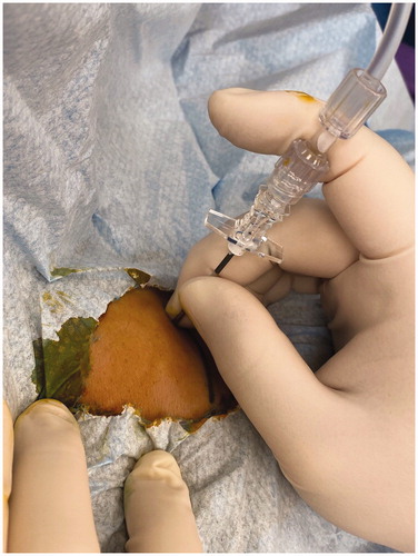 Figure 1. Artificial right pleural effusion technique. The patient is placed in the left-lateral position, and pleural puncture is performed under aseptic technique through the right fourth intercostal space along the mid-axillary line using a 16-gauge epidural needle with Tuohy bevel (B., Braun Melsungen AG, Melsungen, Germany). Ventilation is suspended in the expiratory phase with an open adjustable pressure limit valve when the needle is introduced into the pleural cavity. Correct placement is confirmed when there is a passive loss of resistance to a falling column of fluid. Approximately 800 ml of warm normal saline is infused into the right pleural cavity.