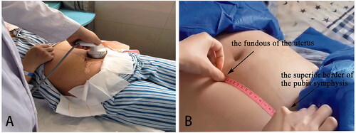Figure 1. (A) The therapeutic process of LIUS; (B)The method to measure the fundal height.