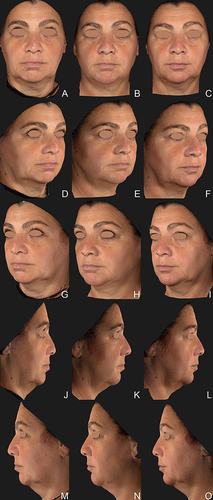 Figure 7 Clinical case 2: 54-year-old woman. A 0.6mL supraperiosteal bolus of HAI was injected in in the pogonium (most anterior point of the chin) and 0.7mL of HAI was injected in each side of the pre-jowl sulcus. A total volume of 1.0mL of CaHA(+) per side was injected in the subcutaneous layer, slightly below the mandible ramus, along its length, while 0.5mL of HAV was injected in the superficial subcutaneous layer along the mandible ramus for further definition. Images taken with Vectra Software. at baseline (A, D, G, J, M), after 30 days (B, E, H, K, N) and 90 days (C, F, I, L, O) after the treatment session.