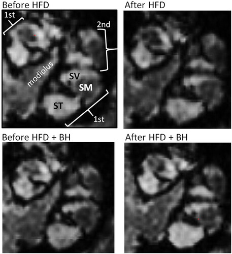 Figure 1. MRI images from mice fed HFD in the absence or presence of betahistine. MRI was performed at day –1 and day 30. Examples of images parallel to the modiolus of cochlea of mice fed HFD were analyzed by MRI both before and after HFD feeding without or with betahistine is shown. The gadolinium contrast agent enhances the MR signal for perilymph (SV and ST, high signal intensity), but not for endolymph (SM, low signal intensity). The ratio of areas was subsequently converted to percentage as shown in Figure 2A and described in methods. SV, scala vestibule; ST, scala tympani; SM, scala media.
