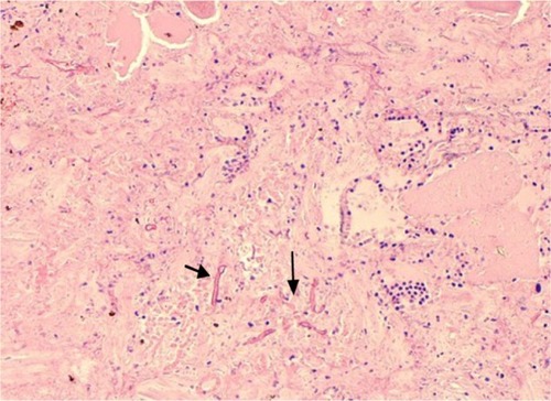 Figure 4 Broad-based pauci-septate hyphae with dichotomous wide-angle branching (arrow) on microscopic examination of thyroid.