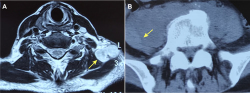 Figure 3 Imaging appearances in case 2. (A) The neck abscess (arrow) on axial MRI. (B) The right psoas abscess (arrow) on axial CT.