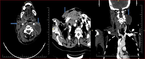 Figure 1 CT scan of the neck shows multiple peripheral contrast-enhancing abscesses in both sides of the neck (bilateral neck abscess).