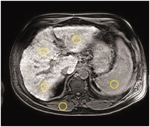 Figure 1. A T1 weighted transversal image at the level of the portal vein bifurcation of a 57-year-old male patient with fibrosis (Child-Pugh score 6 and MELD score 11). Circles show typical placement of the regions of interest to obtain signal intensity (SI) of liver (one in left lobe and two in right lobe), paravertebral muscle, and spleen.