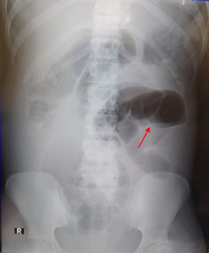 Figure 1 Supine abdominal radiograph showed a large gas-filled dilated bowel loop in the left mid and lower quadrants. The intestinal pneumatosis (arrow) can also be seen in the upper and right lower abdomen.