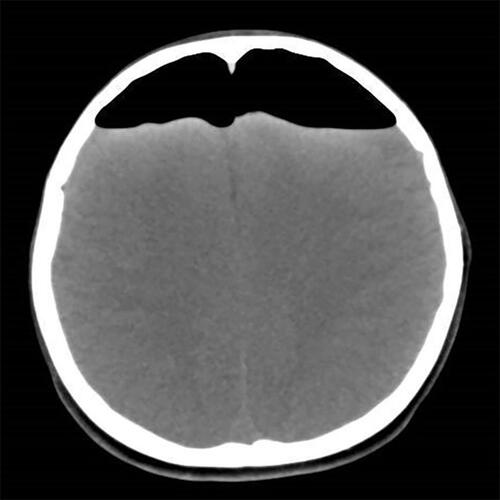 Figure 1 Computed tomography revealing intracranial pneumocephalus, evident at the top of the forehead, and compression of the bilateral frontal lobes.