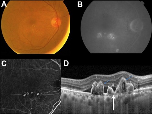 Figure 1 The right eye of a 66-year-old male (case 8) with polypoidal choroidal vasculopathy, initially diagnosed with age-related macular degeneration.