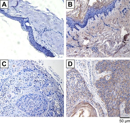 Figure 2 Expression levels of IGFBP3 in normal human skin and cutaneous squamous cell carcinoma tissues.