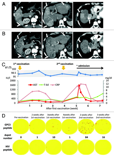 Figure 1. Findings of an early-phase contrast-enhanced CT (CT) scan. (A) Contrast-enhanced CT scan before vaccination shows a 68 × 51-mm tumor with multiple intrahepatic tumors (arrow) and a 44 × 30-mm tumor invading the right atrium (arrowhead). (B) Contrast-enhanced CT after the second vaccination showing multiple low-density areas in the liver, indicating extensive tumor necrosis (arrow). By contrast, a tumor thrombus in the right atrium increased to a 83 × 50-mm tumor (arrowhead). (C) Clinical course from the beginning of GPC3 peptide vaccination. Approximately 1 week after the first vaccination, the patient began reporting general fatigue and showed intermittent fever. Inflammatory and hepatic parameters were elevated (CRP: pink line, AST: red line, T-bil: green line). The abnormal laboratory parameters improved after observation. On day 9 after the second vaccination, the patient was admitted to our hospital as an emergency due to fever and general fatigue, which were similar to his previous symptoms. One day after hospitalization, the inflammatory and hepatic parameters were remarkable. Inflammatory and hepatic parameters improved 1 week after hospitalization. However, his status gradually worsened, and he died on day 30 after the second vaccination. (D) Immunological monitoring of the GPC3 peptide-specific T cell responses. Ex vivo IFN-γ enzyme-linked immunospot (ELISPOT) assays against GPC3 in 5 × 105 peripheral blood mononuclear cells (PBMCs) were performed before and after vaccination. The ∆ spot number indicates the number of GPC3 peptide-specific cytotoxic T-lymphocytes (CTLs). The number of interferon (IFN)-γ positive spots increased from 0 to 84 after the second vaccination.