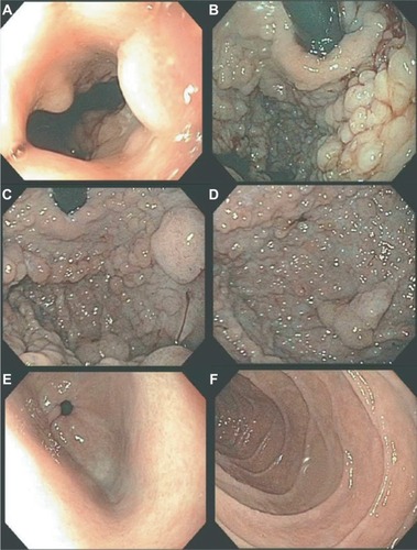 Figure 1 Endoscopy findings of gastric polyposis due to GAPPS.