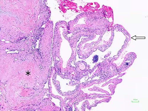 Figure 3 Histological section shows that the lung cyst with mural nodule after minimally invasive thoracoscopic surgery (hematoxylin-eosin staining, ×40): The mural nodule was mainly composed of hyaline degenerated collagen bundles (asterisk). The collapsed lung cyst wall structure was demonstrated at the lateral side of the mural nodule (arrow).