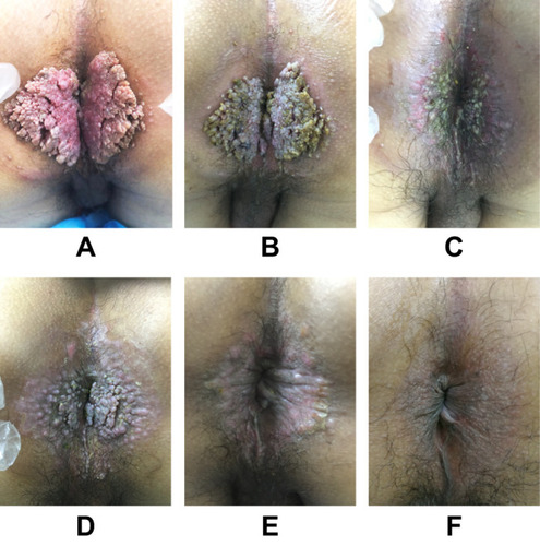 Figure 2 Case 5. (A) Photograph showing massive lesions (11 cm × 10 cm) clustered in the perianal region before treatment. The lesions became smaller after (B) 1 week, (C) 2 weeks, (D) 3 weeks, and (E) 4 weeks of first stage treatment. (F) The lesions disappeared after 10 weeks’ treatment with no scarring.