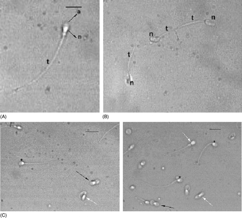 Figure 1  Spermatozoa observed using the PM. (A) Normal cell shows a well shaped acrosome (a) covering the anterior part of the head. It is not birefrigent. The region of the nucleus devoid of acrosome is birefringent (n) as is the entire tail (t). Bar 12.7 μm. (B) Dead abnormal spermatozoa observed. The heads (n) and the tails (t) are not birefringent. (C) Examples of different sperm populations, observed. Normal spermatozoa (*), spermatozoa with normal acrosomes and nuclei but rolled up axonemes (black arrows), spermatozoa with altered nuclei and reduced or absent acrosomes (white arrows) are shown in the bottom panels. Bar 18 μm.