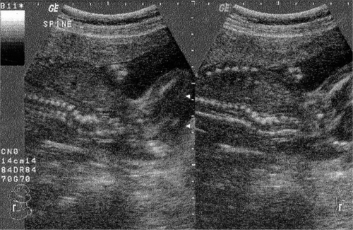 Figure 1 Longitudinal ultrasonographic scans of the spine of a second trimester fetus with hemivertebra.