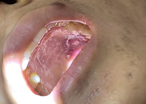 Figure 1 Ulcerative nodules on the patient’s roof of the mouth, and black nodules in corners of the mouth.