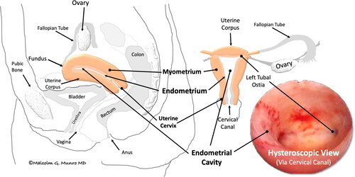 Figure 1. Simplified uterine anatomy and physiology. Depicted is the normally pear-shaped uterus situated anterior to (in front of) the colon, posterior to (behind) the bladder, and attached to the vagina. The hollow organ includes a corpus, primarily comprising specialized muscle (myometrium), lined by a layer of tissue called the endometrium, and a cervix, connecting the endometrial cavity to the vagina via the cervical canal. After conception, the embryo is transferred via the fallopian tube to the endometrial cavity, where it attaches to and is then enveloped by the endometrium, where, as a fetus, it develops until reaching maturity. At that point, in the process of labor, it is expelled from the endometrial cavity by dilation of the cervical canal and contractions of the muscular uterine corpus. If a pregnancy does not occur, the superficial portion of the endometrium, the functionalis, is discharged during menstruation.