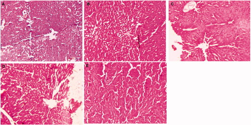 Figure 3. The histopathological evaluation of DEN-induced HCC group rats. (A) DEN control group showed the expansion of hepatic nodules (white in color) and decolorization of tissue, (B) DEN control group treated with GA (25 mg/kg) illustrated the expansion of pre-cancerous nodules (white in color) and decolorization of tissue color, which was less as compared to DEN group, (C) DEN control group treated with GA (50 mg/kg) demonstrated the less pre-cancerous nodules (white in color) and decolorization of tissue color, (D) DEN control group treated with GA (100 mg/kg) illustrated the expansion of pre-cancerous nodules and decolorization of tissue color, which was less as compared to other group, and (E) DEN control group treated with GA-NLC (25 mg/kg) illustrated the decolorization of tissue color, which was less as compared to other group rats. Note: Normal control and normal control rats treated with GA (100 mg/kg) did not show any sign of alteration in the histopathology (data not shown).