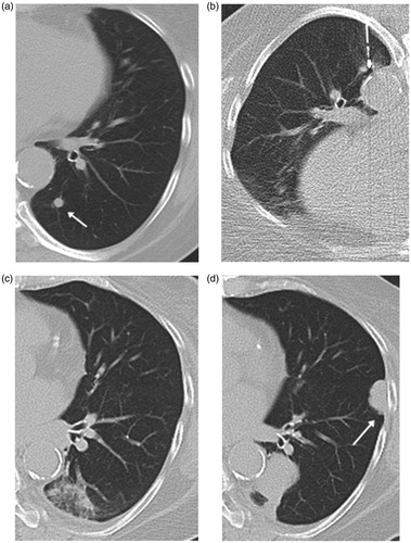 Figure 4. Axial CT images in 62-year-old female patient with solitary metastasis in the left lower lobe from breast cancer treated with RFA. (a) CT image prior to ablation showing a nodular metastatic lesion in the left lower lobe (arrow). (b) Image obtained during the ablation session showing the RFA-electrode in situ. (c) CT image obtained 24 h after ablation showing the perilesional ground glass opacification induced by ablation therapy. (d) CT image 18 months after ablation shows local tumour progress as well as the appearance of metachronous pulmonary metastatic lesion (arrow).