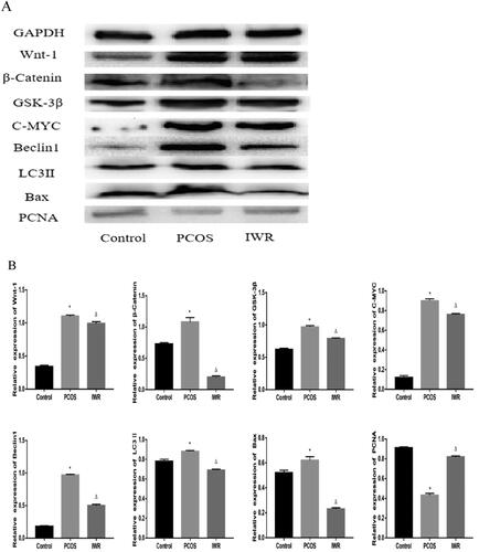 Figure 8. Wnt/β-catenin signaling pathway is involved in regulating autophagy, apoptosis and proliferation in ovarian tissues of PCOS rats. A: The image of western blot band. B: The expression of proteins including Wnt-1, β-Catenin, GSK-3β, C-MYC, Beclin1, LC3II, Bax, and PCNA. Data are shown as means ± SD (n =3), and data between multiple groups were compared by one-way ANOVA. Compared with the normal group, *p < 0.05; compared with the PCOS group, △p < 0.05.