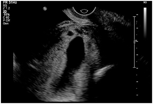 Figure 1. Thirty-two-year-old patient, G2P1, 62 days gestation, no lower abdominal pain or vaginal bleeding. Blood β-HCG 114,384 IU/ml. Ultrasound examination showed an elongated gestational sac of which the lower extremity located at the cesarean section scar (anterior lower segment) with scattered anechoic foci within chorion.