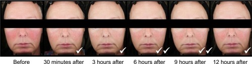 Figure 3 Standardized photos of a representative subject before and at 30 minutes, 3 hours, 6 hours, 9 hours, and 12 hours after the application of brimonidine tartrate gel on day 1.