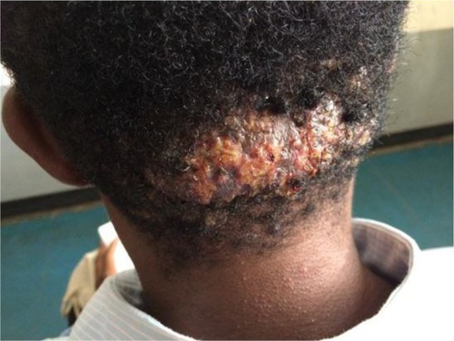 Figure 2 Acne keloidalis: plaque form with secondary infection.