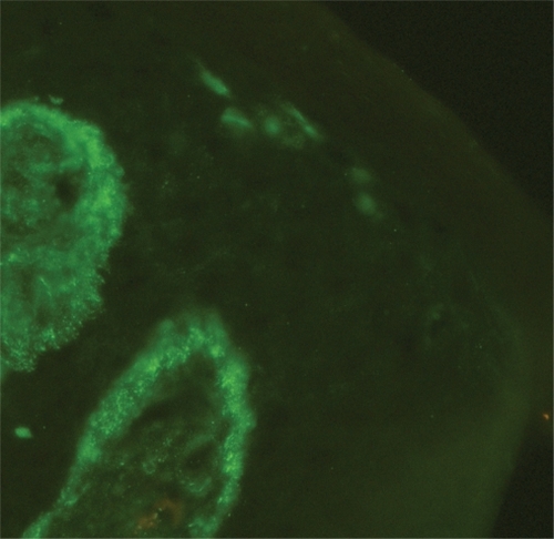 Figure 5 Shaggy pattern of complement component 3 deposits in sun-protected lesional skin in patients with subacute cutaneous lupus erythematosus.