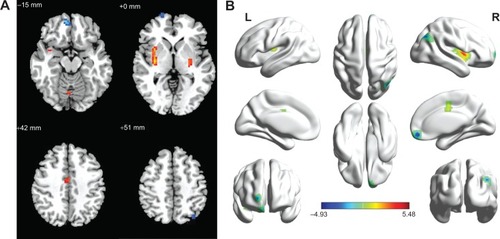 Figure 1 Regional homogeneity modeled in the magnetic resonance images of the subjects in the transverse orientation, shown at four different levels through the brain (A). The modeled surface of the brain shown in different orientations. The red color signifies an increase in ReHo areas, and the blue signifies a decrease in ReHo areas (B).