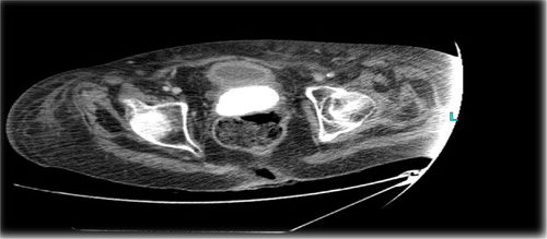 Fig. 3 CT scan showing calcified IUCD.