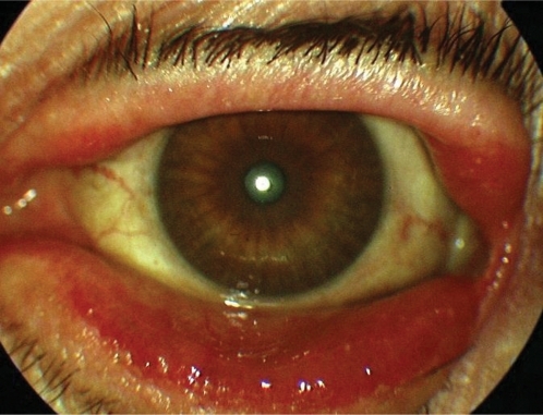 Figure 3 The color photograph shows cataractous lens and the lower ectropion in the left eye.