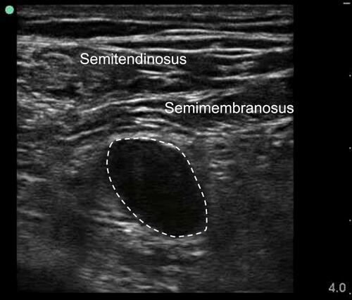 Figure 2 The ultrasonography of the stump neuroma. Dash line showed the neuroma hypoechoic shadow on ultrasonography.