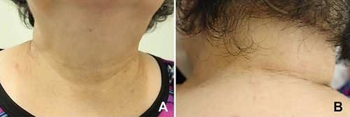 Figure 3 Significant improvement of the lesions at the 2-week follow-up visit (A and B).