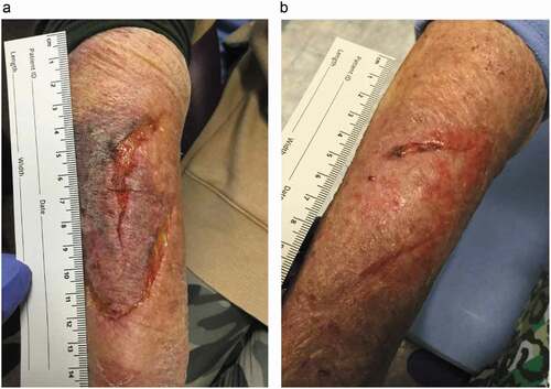 Figure 4. Arm redness, bruising after trauma