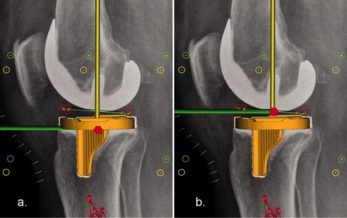 Figure 2. Lateral views showing the different reference origins (center of migrating model at reference time point T0) in (a) model-based and (b) marker-based RSA. The longitudinal axis is represented by the yellow line, the sagittal axis by the green line, and the red hexagon represents the origin. To fully compare model-based and marker-based RSA data using the same reference origin, a second model-based analysis was performed with the reference origin fixed in the center of the polyethylene markers as shown in b.